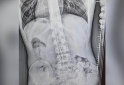 Midesinde 309 gram uyuşturucuyla yakalandı