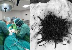 Zihinsel engelli kadın hastanın midesinden 1 kilo metal cisim çıktı