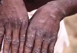 Sierra Leone'de Maymun çiçeği vakaları nedeniyle ‘acil durum’ ilan edildi