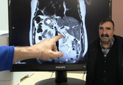 Bütün iç organları ters yerde; karın ağrısı şikayetinden dünyada yapılan 47'nci işlemle kurtuldu