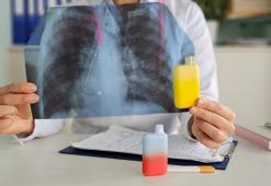 ‘Elektronik sigara kullanımına bağlı 'evali sendromu' akciğerlerde kalıcı hasara neden olabiliyor’
