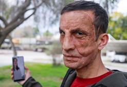 Babasının yüzünün nakledildiği Uğur'la duygulandıran görüşme