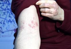 'Egzama artık modern yöntemlerle tedavi edilebilir bir hastalık'