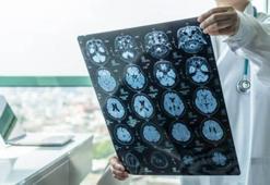 Araştırma: Bunamanın ilk belirtisi 11 yıl önce ortaya çıkıyor