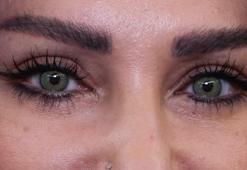 Göz rengi değiştirme ameliyatlarına talep artıyor; en çok ‘yeşil’ tercih ediliyor