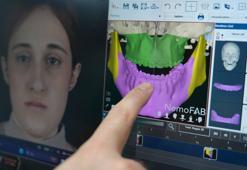 Tek yumurta ikizlerine, 3 boyutlu modelleme ile çene ameliyatı