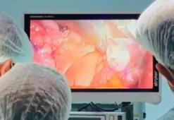 Bitlis’te ilk kez V-NOTES tekniği ile başarılı rahim alma ameliyatı yapıldı