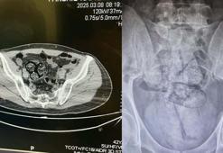 İranlı şüphelinin bağırsağından uyuşturucu çıktı