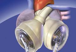 Avustralyalı hasta yapay kalple 100 gün hayatta kaldı