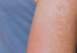 ABD'nin Teksas eyaletindeki kızamık salgınında vaka sayısı 223'e yükseldi