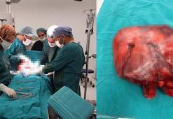 Rahminden 35 santimlik miyom çıktı