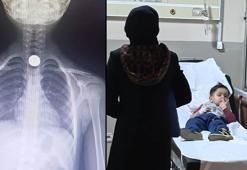 Yusuf'un yemek borusuna takılan madeni para operasyonla çıkartıldı