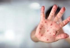 ABD'de kızamık salgını nedeniyle bir çocuk daha hayatını kaybetti