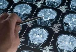 Uyku ilacı, Alzheimer ile ilişkili proteinlerin birikimini azaltabilir