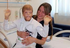 Gözleri kurtarılan Myhailo'ya, şimdi kulak kepçesi yapılacak