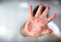 ABD'nin Texas eyaletindeki kızamık salgınında vaka sayısı 624'e yükseldi