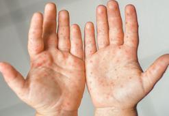 Japonya'da kızamık vakaları artıyor