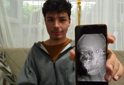 Yusuf, başındaki yorgun mermi nedeniyle 1,5 yıldır her gün ölüm korkusu yaşıyor