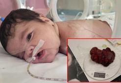 34 haftalık doğan Eymen bebeğin boynundan 445 gram tümör çıkarıldı