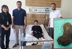 9 yaşındaki çocuğun midesinden saç yumağı çıktı