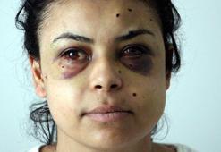 Düğünde tüfekle ateş açıldı, penceredeki Nazar gözlerinden yaralandı