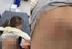 Sokak köpeklerinin saldırısına uğrayan Zeynep, yaralandı