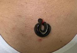 Sülük salgısıyla kalp krizi riskine karşı alternatif tedavi