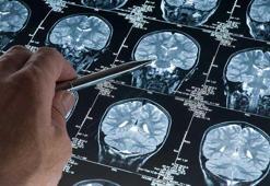 Alzheimer araştırmalarında riski artıran genetik varyant bulundu