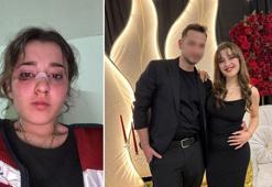 Tatil dönüş planı tartışmasında nişanlısını plajda motosiklet kaskıyla dövdü