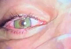 Göz rengini kalıcı olarak değiştirmek mümkün; en çok mavi ve yeşil uygulanıyor