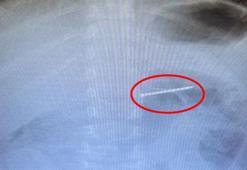 2 yaşındaki bebeğin yuttuğu çivi midesinden çıkarıldı