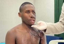 Yüzü yanan Ugandalı çoban Ankara'da tedavi edildi