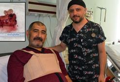 Kalbinden 10 santim büyüklüğünde kitle çıkarıldı