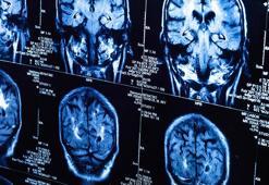 Araştırma: Covid-19 beyni yaşlandırdı