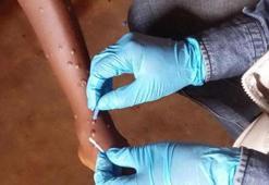 Gana'da M-çiçeği vaka sayısı 302'ye yükseldi