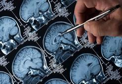 Alzheimer tedavisinde 'lityum' umudu