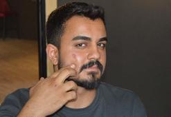 Lazer epilasyonda yüzü yandı, işletme hakkında şikayetçi oldu