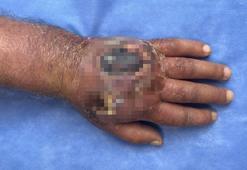 Hırsızın ısırığı kolundan ediyordu; vaka literatüre girmeye aday