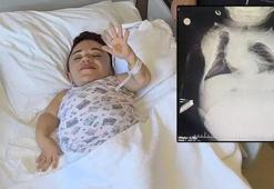 24 kilo ağırlığındaki Nurdan'ın yumurtalıklarından 3 kilo kist çıkarıldı