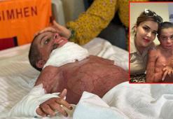 Vücudunun yüzde 50'si yanan Mustafa, yapay deri nakliyle hayata tutundu