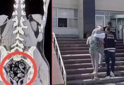 Röntgenle tespit edilen uyuşturucu cerrahi operasyonla çıkarıldı