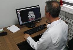 Prof. Dr. Terzi: Türkiye’de inme ve felçten dolayı her yıl 45 bin insan ölüyor