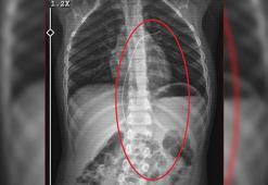 Salatalık yutunca rahatsızlandı; 3 yıl önce vücudunda 18 santimlik kateter unutulduğu ortaya çıktı