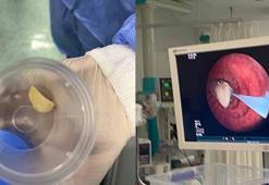 Hastanın akciğerine kaçan sarımsak operasyonla çıkarıldı