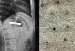 3 yaşındaki çocuğun yuttuğu 19 mıknatıs endoskopiyle çıkarıldı