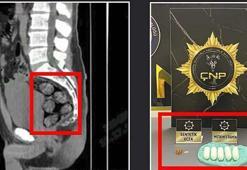 İran'dan midesinde getirdiği 173,15 gram metamfetamin ile yakalandı