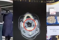 Midesinden yarım kilo metamfetamin çıktı