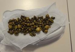 Bursa'da 77 yaşındaki kadının safra kesesinden 213 tane taş çıkarıldı