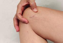 ‘Lipödem, selülit gibi yüzeysel bir kozmetik sorun değil’