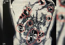 Yabancı uyruklu 2 kişinin mide ve bağırsaklarından uyuşturucu çıktı